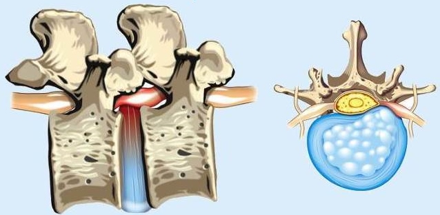 איור פריצת דיסק בכלב