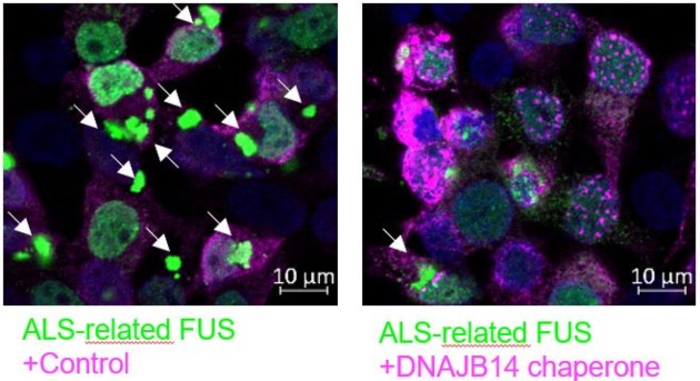 תאים המבטאים חלבון FUS עם מוטציה הגורמת למחלת ALS (מסומן בירוק). חלבון זה יוצר אגרגטים בתוך התאים (חיצים לבנים). כאשר מבטאים בנוסף את השפרון DNAJB14 (מסומן בוורוד, תמונה ימנית), התאים מייצרים הרבה פחות אגרגטים של FUS מוטנטי. איור באדיבות הטכניון