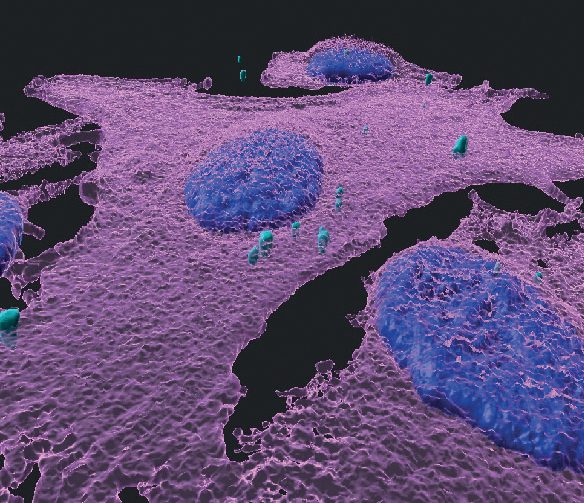 תמונת תלת-ממד של תאי מלנומה (בוורוד, גרעיני התאים - בכחול) הנגועים בחיידקים (מסומנים בטורקיז), צילום באדיבות מכון ויצמן למדע