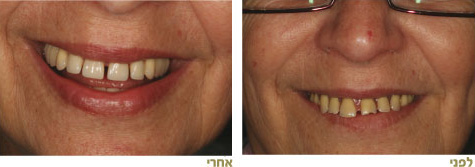 גשרים