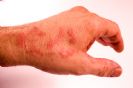 שמירת עור הידיים באלרגיה