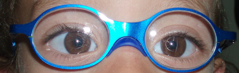Accommodative Esotropia