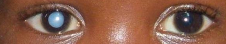 Congenital Cataract