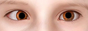 Strabismus