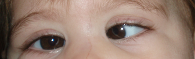 esotropia