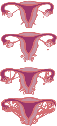 אינה בקר - טיפול  באנדומטריוזיס וכאבי אגן