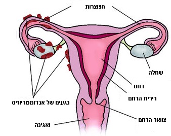 אינה בקר - טיפול  באנדומטריוזיס
