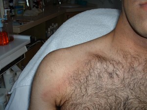 העלמת צלקות