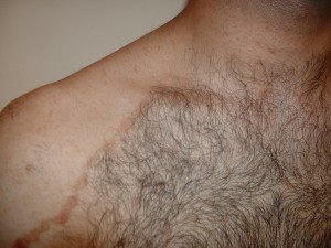 העלמת צלקות