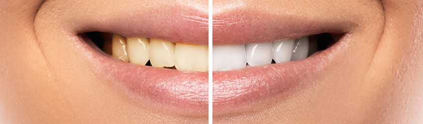 שנטיב - הלבנת שיניים