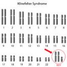 תסמונת קליינפלטר - XXY-syndrome