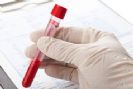 כל מה שרציתם לדעת על בדיקות דם חלק 2 – כימיה